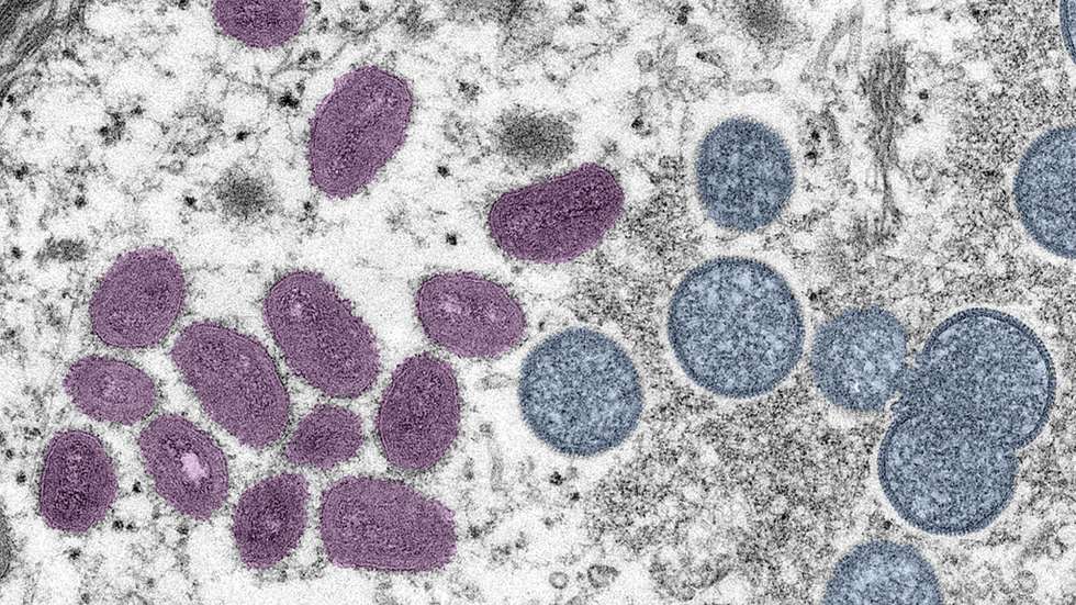 Atualmente, a DGS já registou 241 casos de varíola dos macacos em Portugal