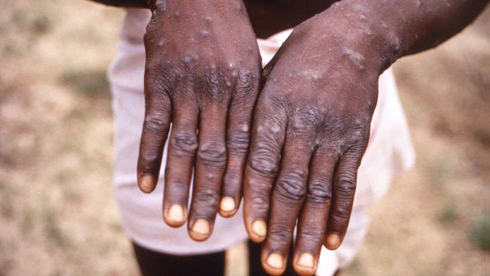 Monkeypox Lesions