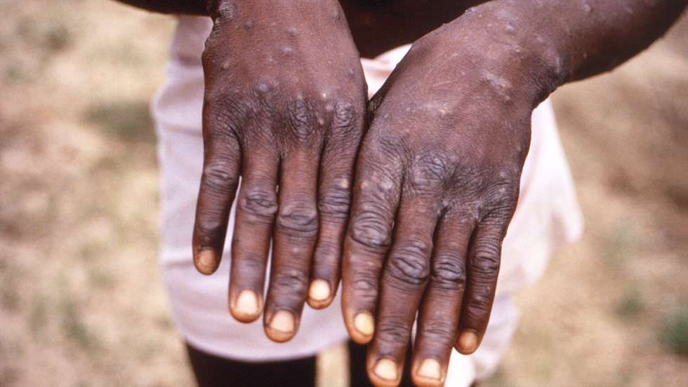 Monkeypox Lesions
