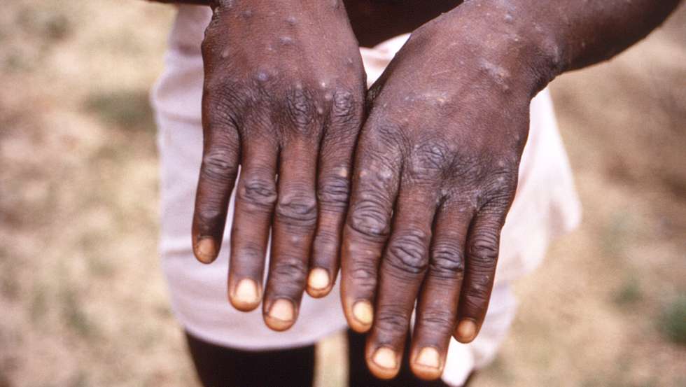 Monkeypox Lesions