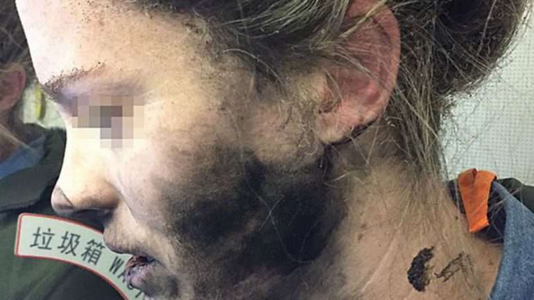 As marcas da explosão na cara da australiana são visíveis