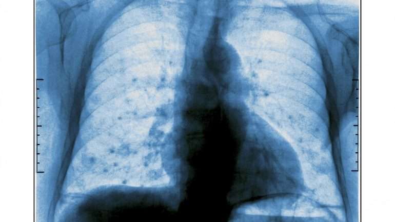 As doenças oncológicas são a segunda causa de morte em  Portugal. Há já 50 mil casos anuais e cancro do pulmão é o que mais mata