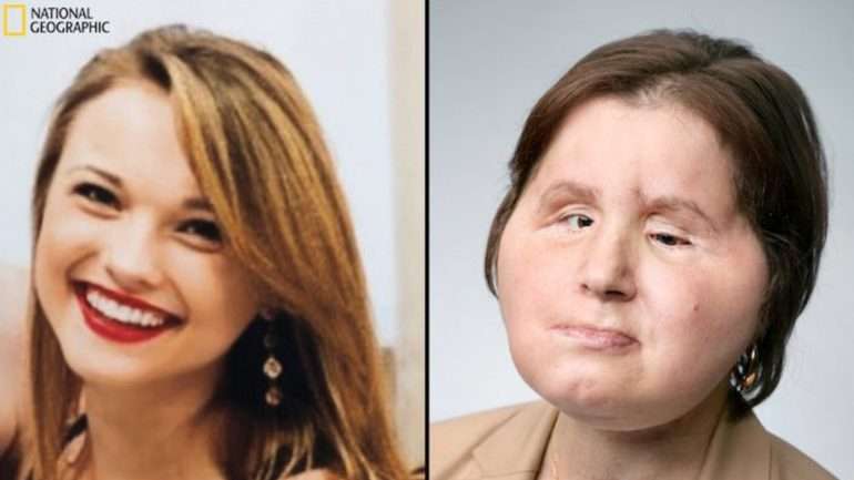 Katie Stubblefield antes da tentativa de suicídio e depois do transplante