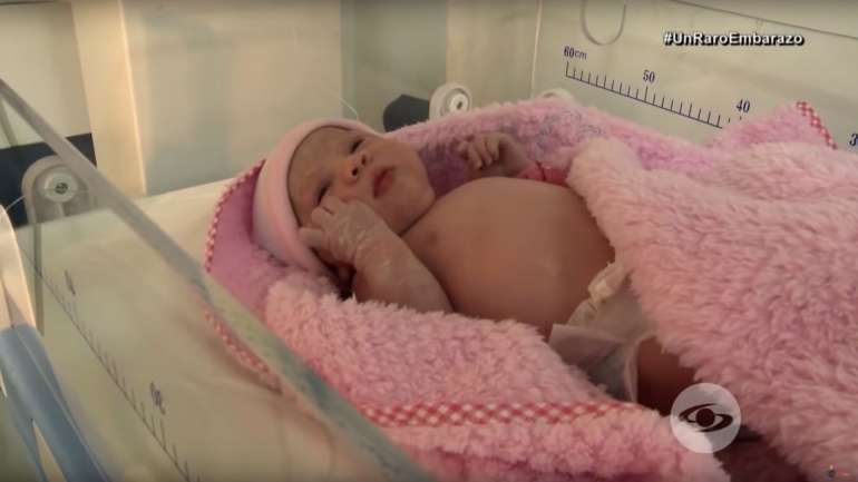 Esta é a bebé que trazia na barriga o feto do irmão gémeo.