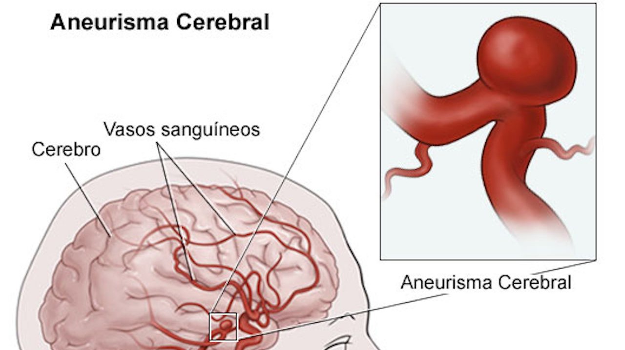 O aneurisma cerebral surge nas curvas ou bifurcações das artérias do cérebro