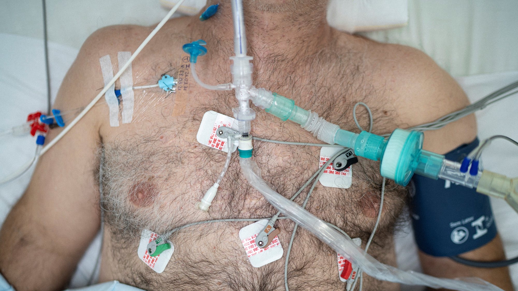 epa09094352 The chest of a patient who in turn is intubated in the Centenario hospital, in SÃ£o Leopoldo, Rio Grande do Sul, Brazil, 23 March 2021 (Issued 24 March 2021). The country will possibly reach the figure of 300,000 deaths on 24 March from causes related to the coronavirus. SÃ£o Leopoldo, a city in the Porto Alegre metropolitan region, has just over 230,000 inhabitants and a single municipal hospital, with 18 beds to provide intensive care to COVID-19 patients.  EPA/Daniel Marenco