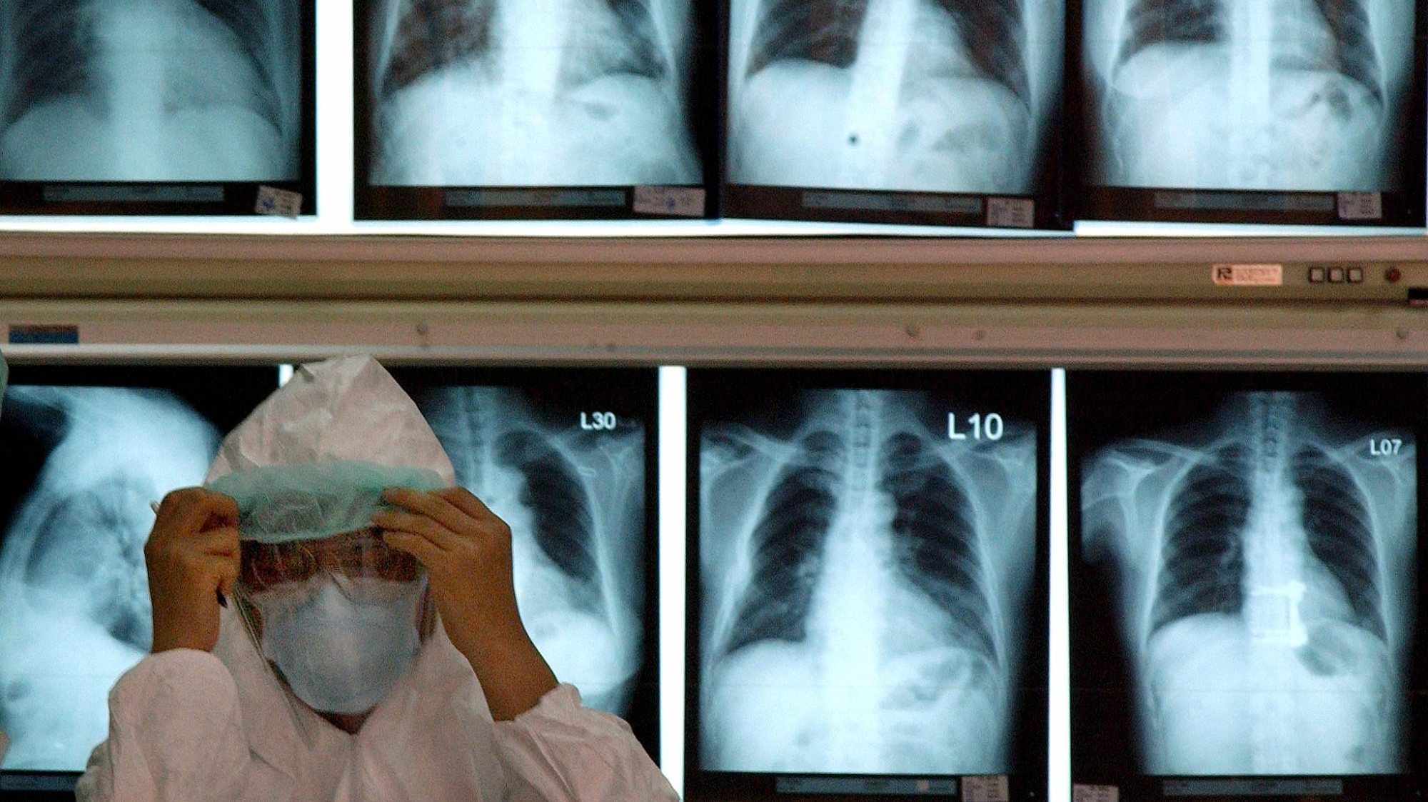 Universidade de Kyoto faz transplante pioneiro de pulmões a paciente vítima de Covid-19