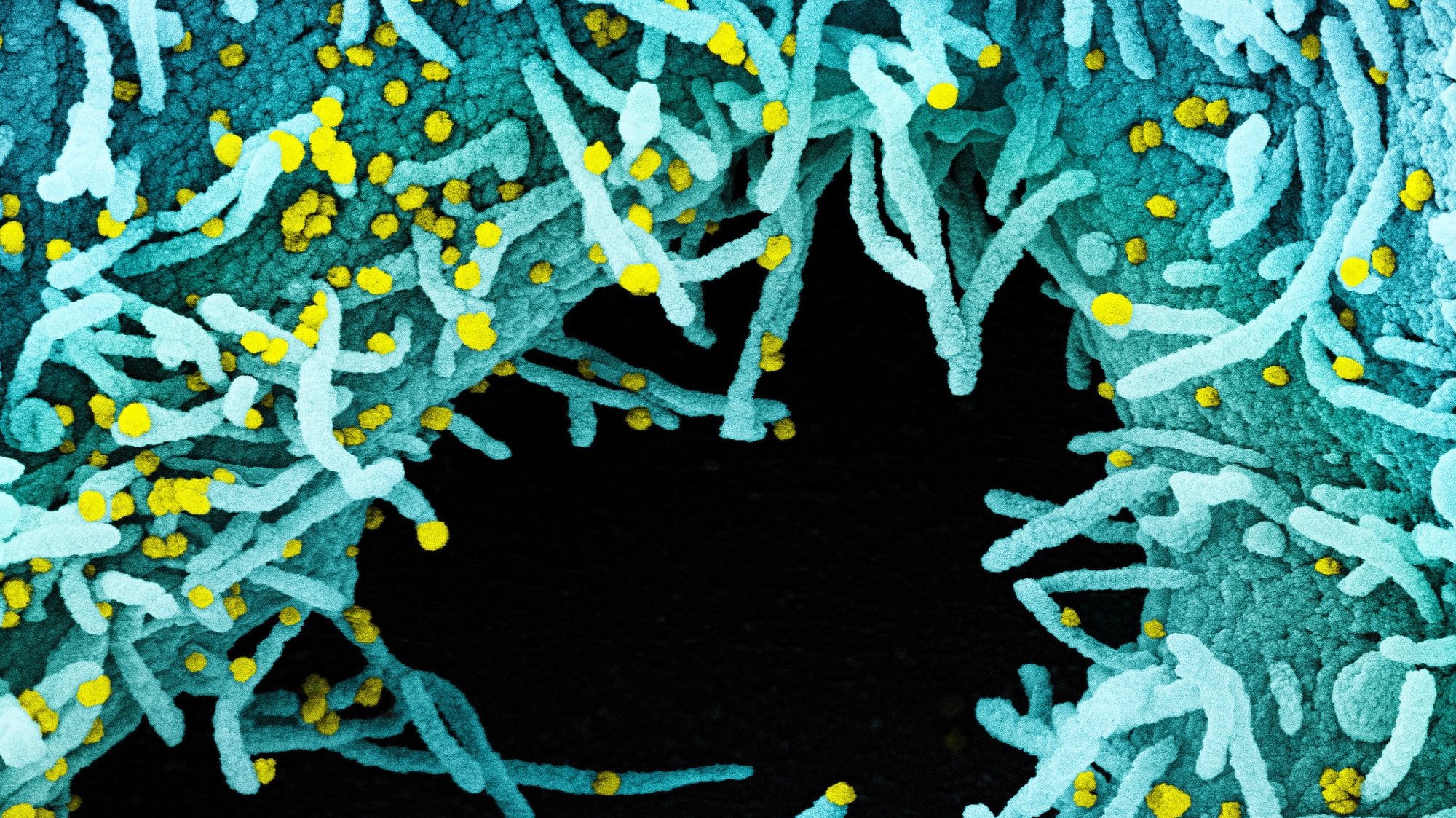 epa08546705 An undated handout image captured and color-enhanced at the National Institute of Allergy and Infectious Diseases (NIAID) Integrated Research Facility (IRF) in Fort Detrick, Maryland, USA and made available by the National Institutes of Health (NIH) shows a colorized scanning electron micrograph of a cell heavily infected with SARS-CoV-2 virus particles (yellow), isolated from a patient sample (issued 15 July 2020). The black area in the image is extracellular space between the cells. The novel coronavirus SARS-COV-2, which causes the COVID-19 disease, has been recognized as a pandemic by the World Health Organization (WHO) on 11 March 2020.  EPA/NIAID/NATIONAL INSTITUTES OF HEALTH HANDOUT  HANDOUT EDITORIAL USE ONLY/NO SALES *** Local Caption *** 56102666
