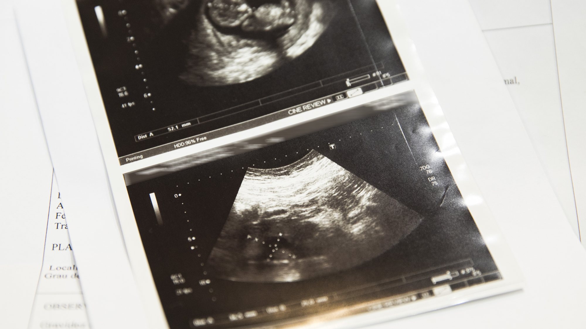 Kelsey Hatcher nasceu com dois úteros funcionais e ambos os órgãos conseguiram constituir gravidez em simultâneo. Caso é considerado &quot;raríssimo&quot; pelos especialistas