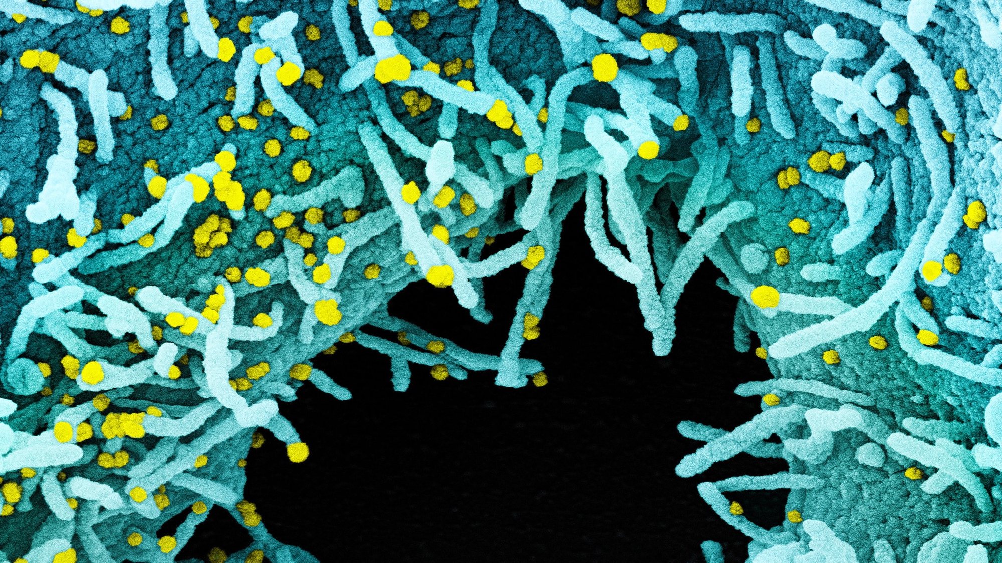 epa08546705 An undated handout image captured and color-enhanced at the National Institute of Allergy and Infectious Diseases (NIAID) Integrated Research Facility (IRF) in Fort Detrick, Maryland, USA and made available by the National Institutes of Health (NIH) shows a colorized scanning electron micrograph of a cell heavily infected with SARS-CoV-2 virus particles (yellow), isolated from a patient sample (issued 15 July 2020). The black area in the image is extracellular space between the cells. The novel coronavirus SARS-COV-2, which causes the COVID-19 disease, has been recognized as a pandemic by the World Health Organization (WHO) on 11 March 2020.  EPA/NIAID/NATIONAL INSTITUTES OF HEALTH HANDOUT  HANDOUT EDITORIAL USE ONLY/NO SALES *** Local Caption *** 56102666