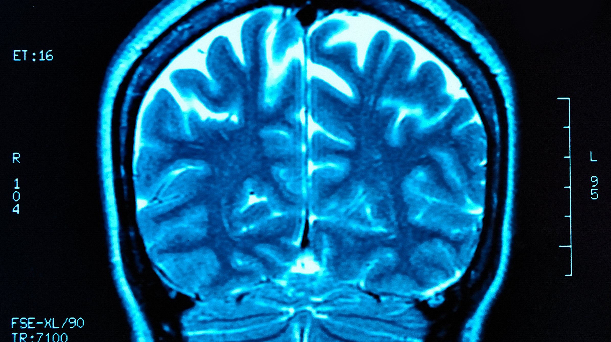 MRI a um cérebro