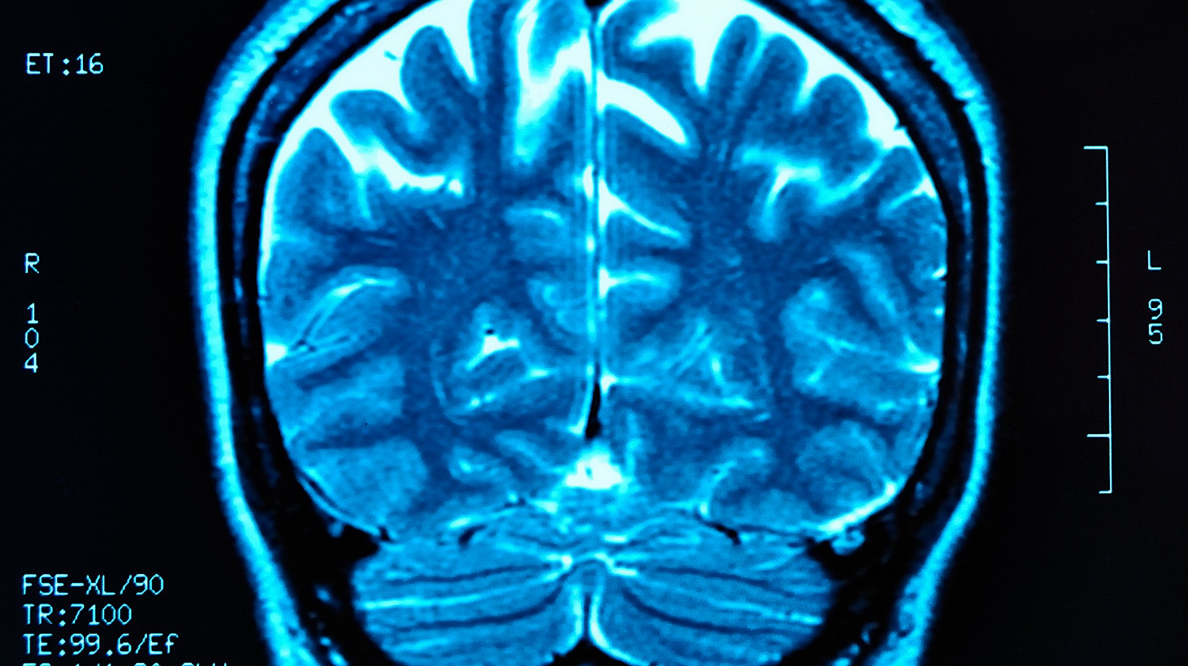 MRI a um cérebro