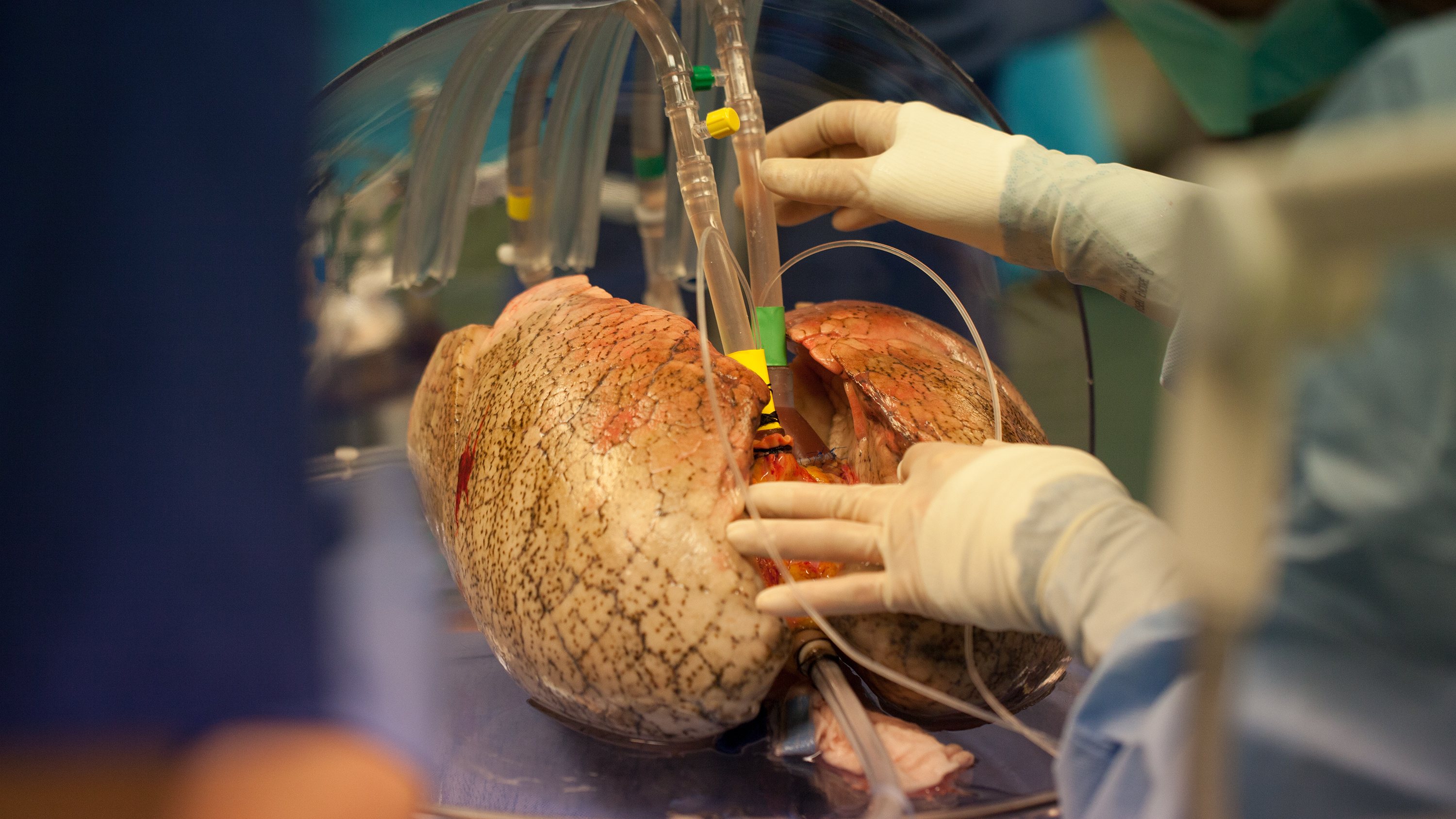Double-lung Transplant Surgery