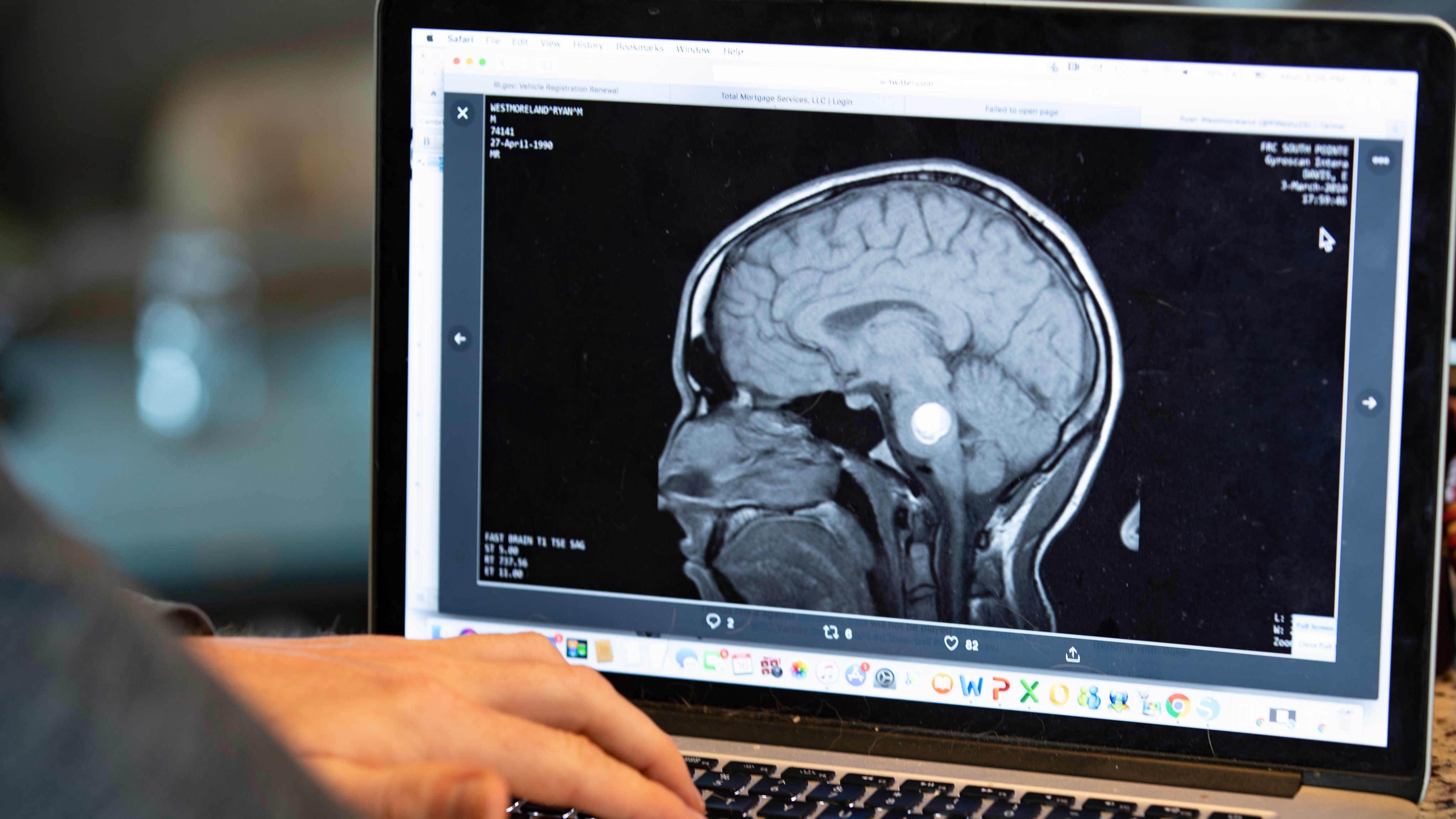 Radiografia que mostra um tumor cerebral