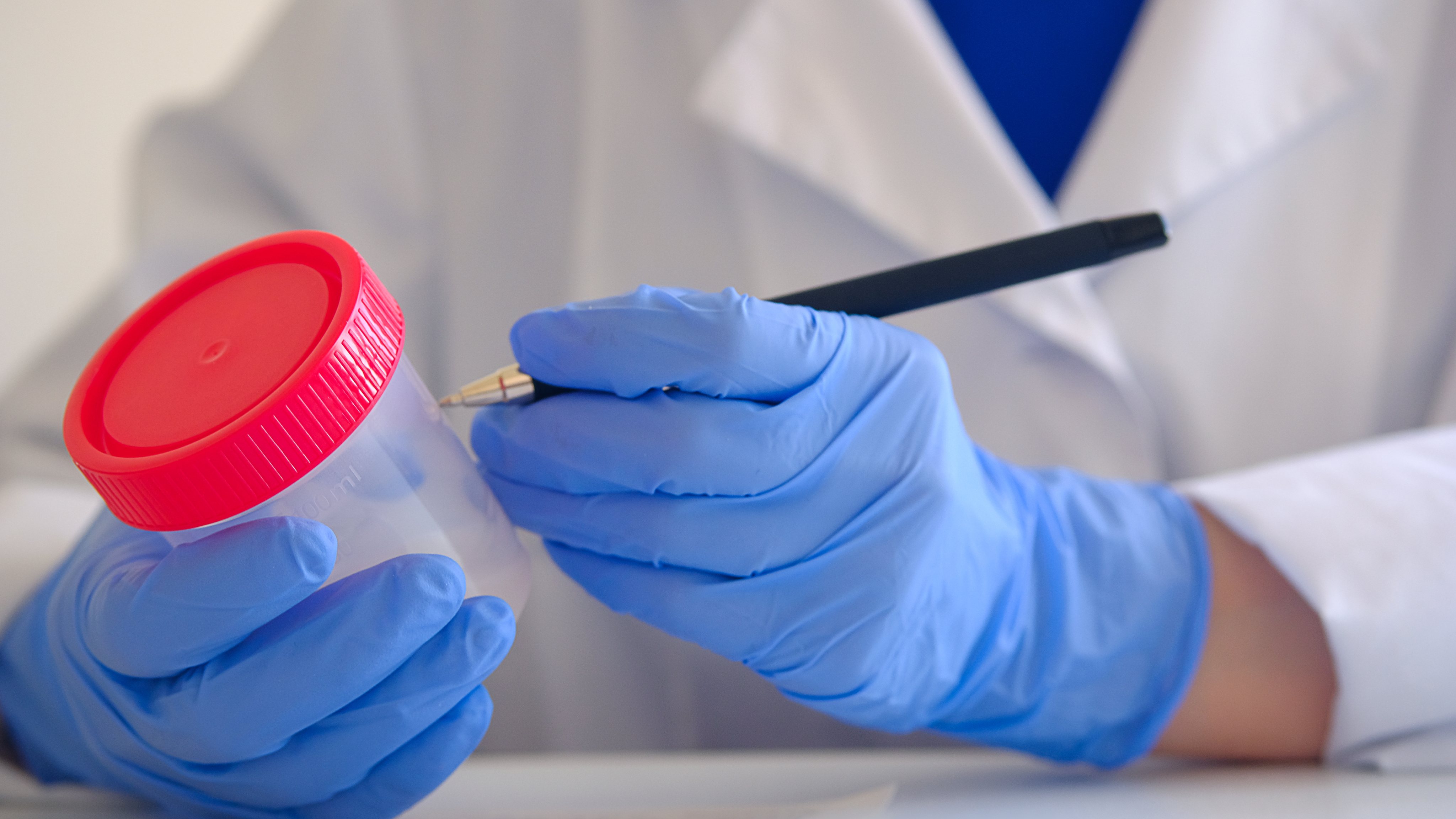 A container with a sperm analysis. Nearby, a doctor&#039;s hand in medical gloves fills out documents and forms. Donor sperm for artificial insemination, infertility treatment, child planning. Passing an analysis for the detection of pathology. Men&#039;s health.