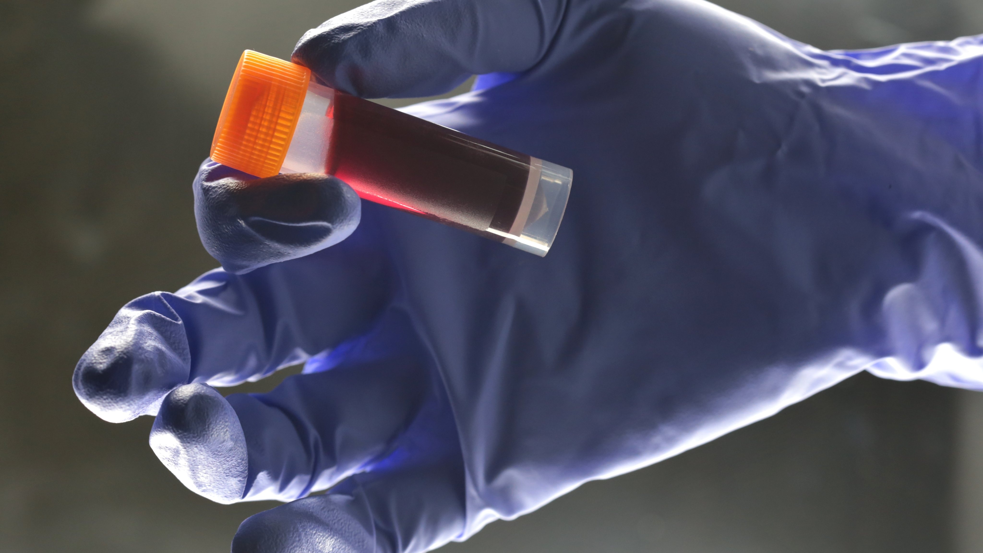 Medical Lab technician hold sample blood for testing