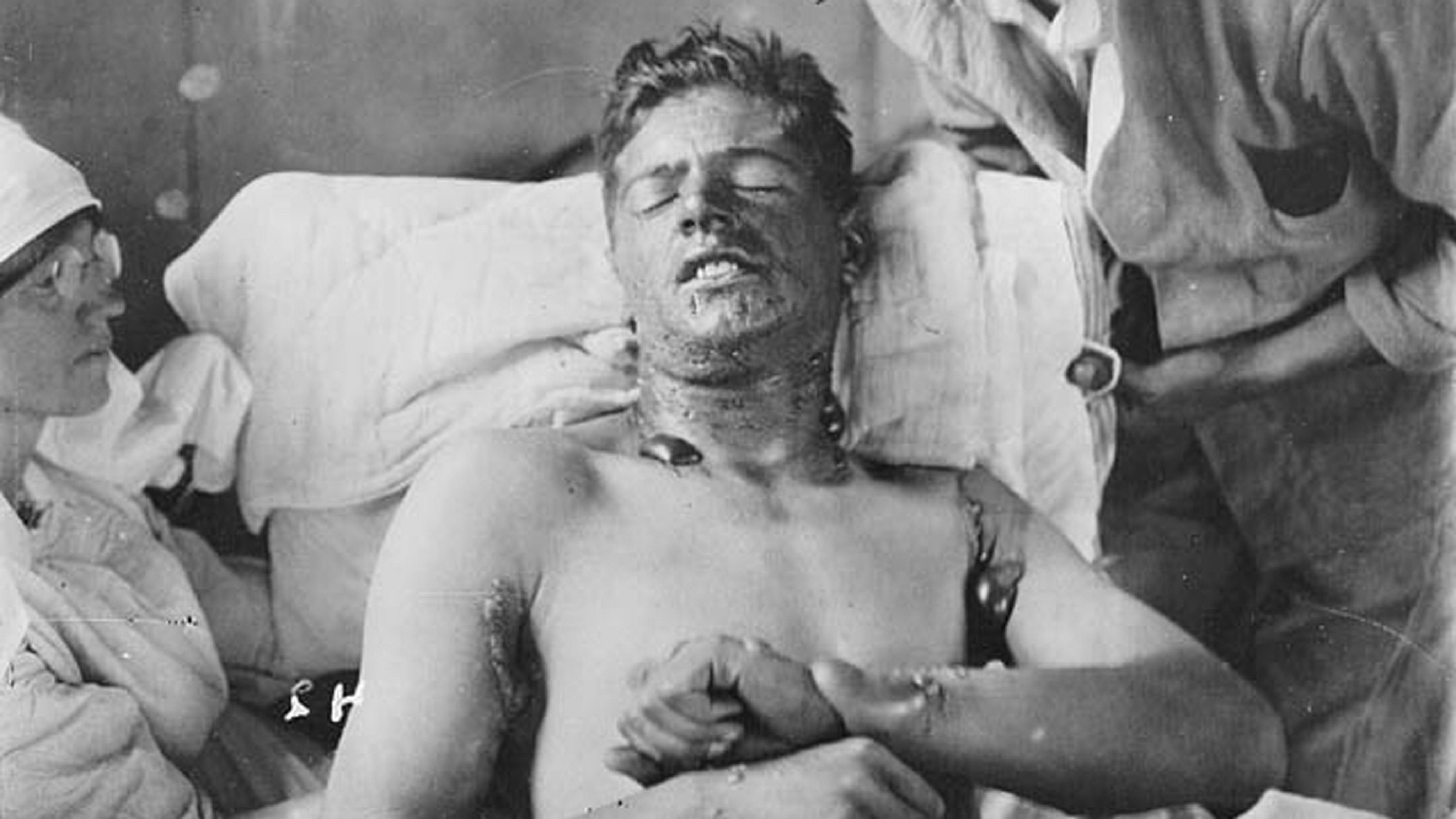Canadian soldier in a field hospital, with mustard gas burns.