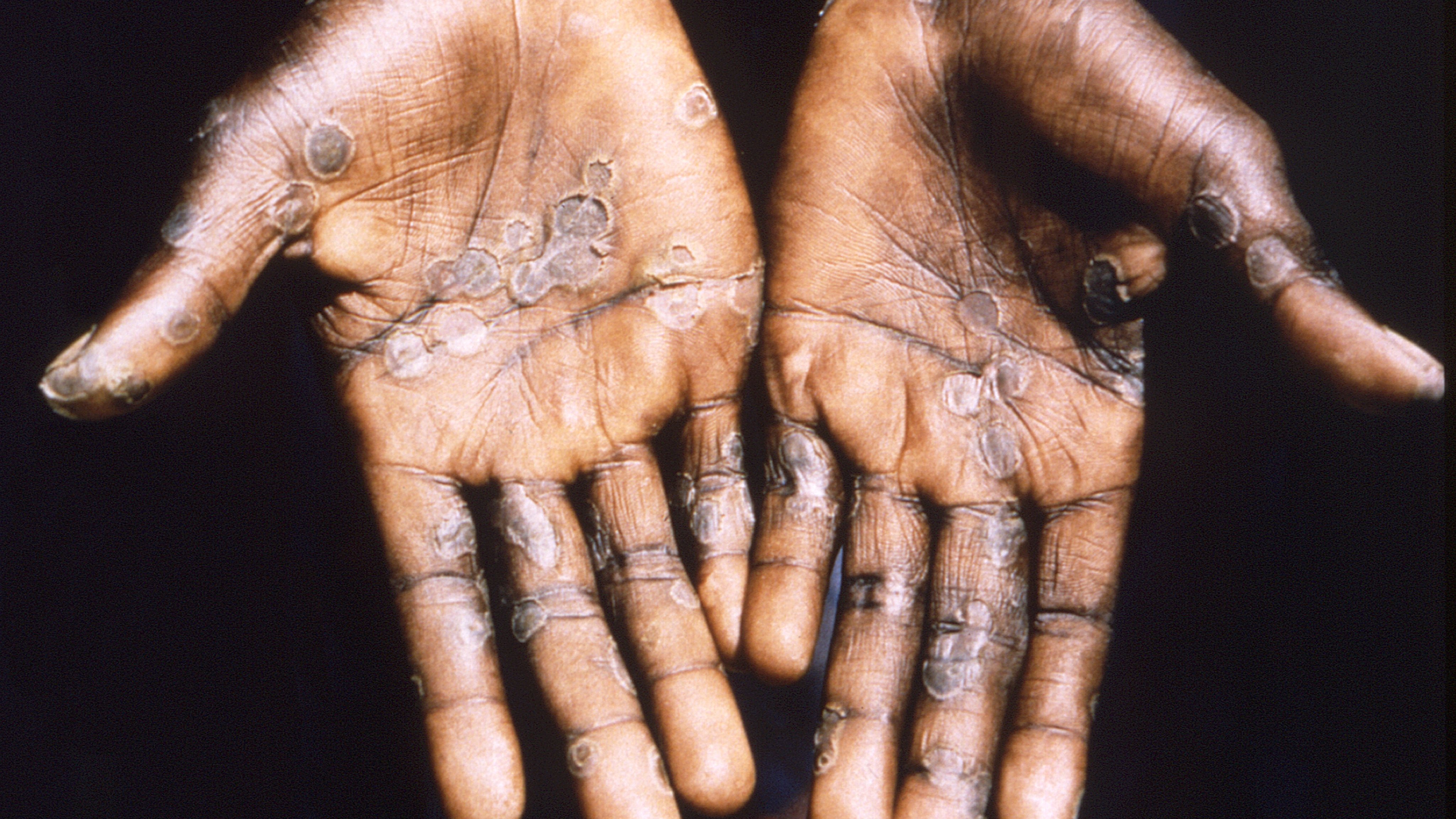 Monkeypox Lesions On Hands