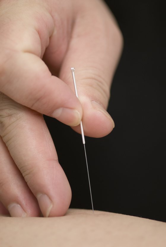 acupuncture, acupuncturist, close-up, needle, puncture, doctor, pain, body, skin, chinese, hand, finger, nerve, medicine, traditional, asia, healthcare, curative, medicative, disease, acupuncture, acupuncturist, close-up, needle, puncture, doctor, pain, body, skin, chinese, hand, finger, nerve, medicine, traditional, asia, healthcare, curative, medicative, disease, 