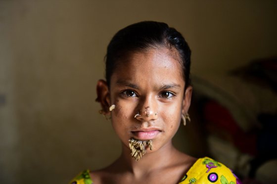 TOPSHOT - In this photograph taken on January 30, 2017, Bangladeshi patient Sahana Khatun, 10, poses for a photograph at the Dhaka Medical College and Hospital. A young Bangladeshi girl with bark-like warts growing on her face could be the first female ever afflicted by so-called "tree man syndrome", doctors studying the rare condition said January 31. Ten-year-old Sahana Khatun has the tell-tale gnarled growths sprouting from her chin, ear and nose, but doctors at Dhaka's Medical College Hospital are still conducting tests to establish if she has the unusual skin disorder. / AFP / STR (Photo credit should read STR/AFP/Getty Images)