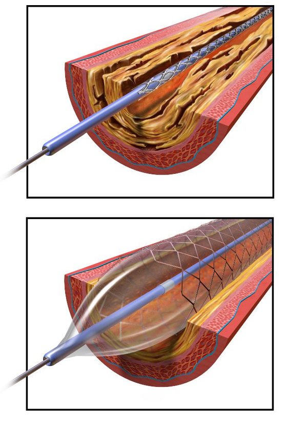 ColocaÃ§Ã£o de um stent num vaso sanguÃ­neo com placas aterosclerÃ³ticas