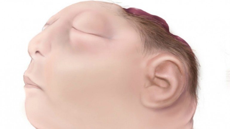 O feto da rapariga que será indemnizada tinha uma grave malformação: anencefalia, que consiste na falta de grande parte do cérebro