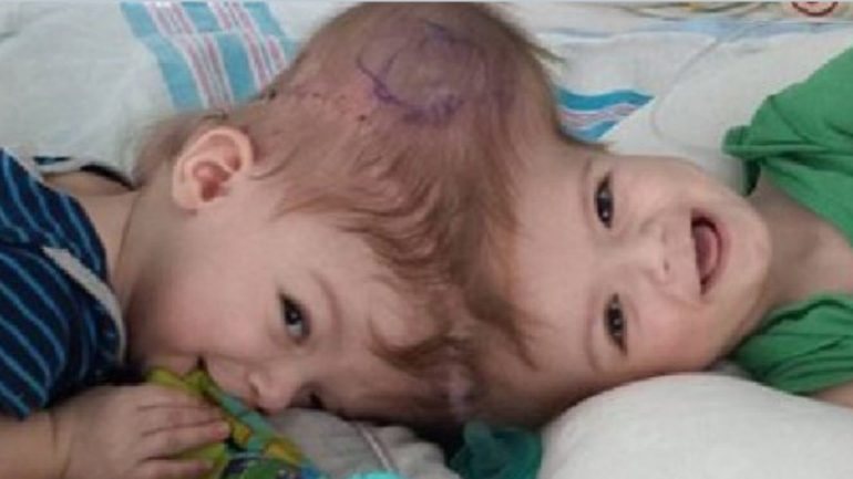 Gémeos veem-se pela primeira vez após cirurgia que os separou