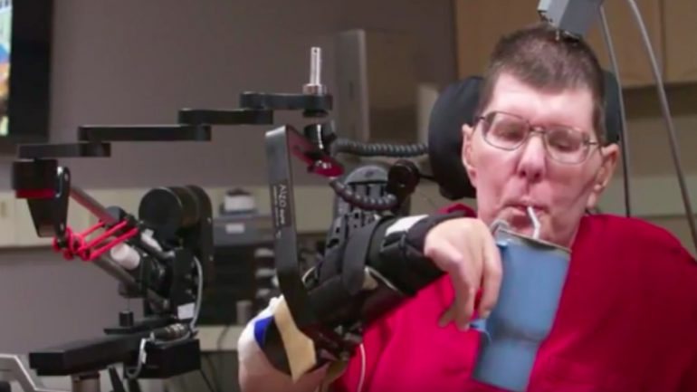 Bill Kochevar levou implantes elétricos no córtex cerebral e sensores nos seus braços, de forma a permitir uma estimulação dos músculos
