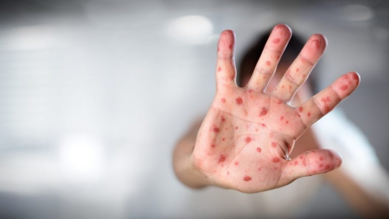 As manchas avermelhadas na pele são um dos sintomas do sarampo