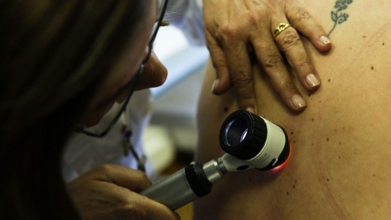 Estima-se que surjam este ano mais doze mil novos casos de cancro de pele, mil dos quais de melanoma