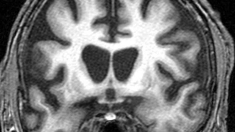 Imagem do cérebro de um doente com a doença de Huntington