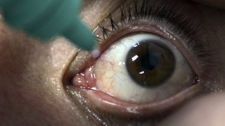 Esta infeção causa uma inflamação da córnea que pode comprometer a visão