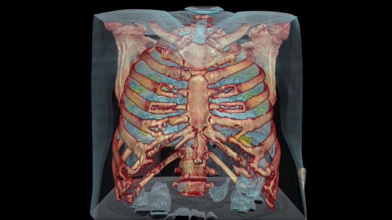 O hospital utilizou a tecnologia de tomografia computadorizada para fazer o vídeo
