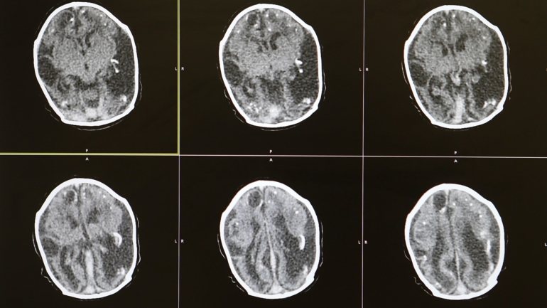 A investigação encontrou danos cerebrais em 19% dos indivíduos que morreram de Covid-19
