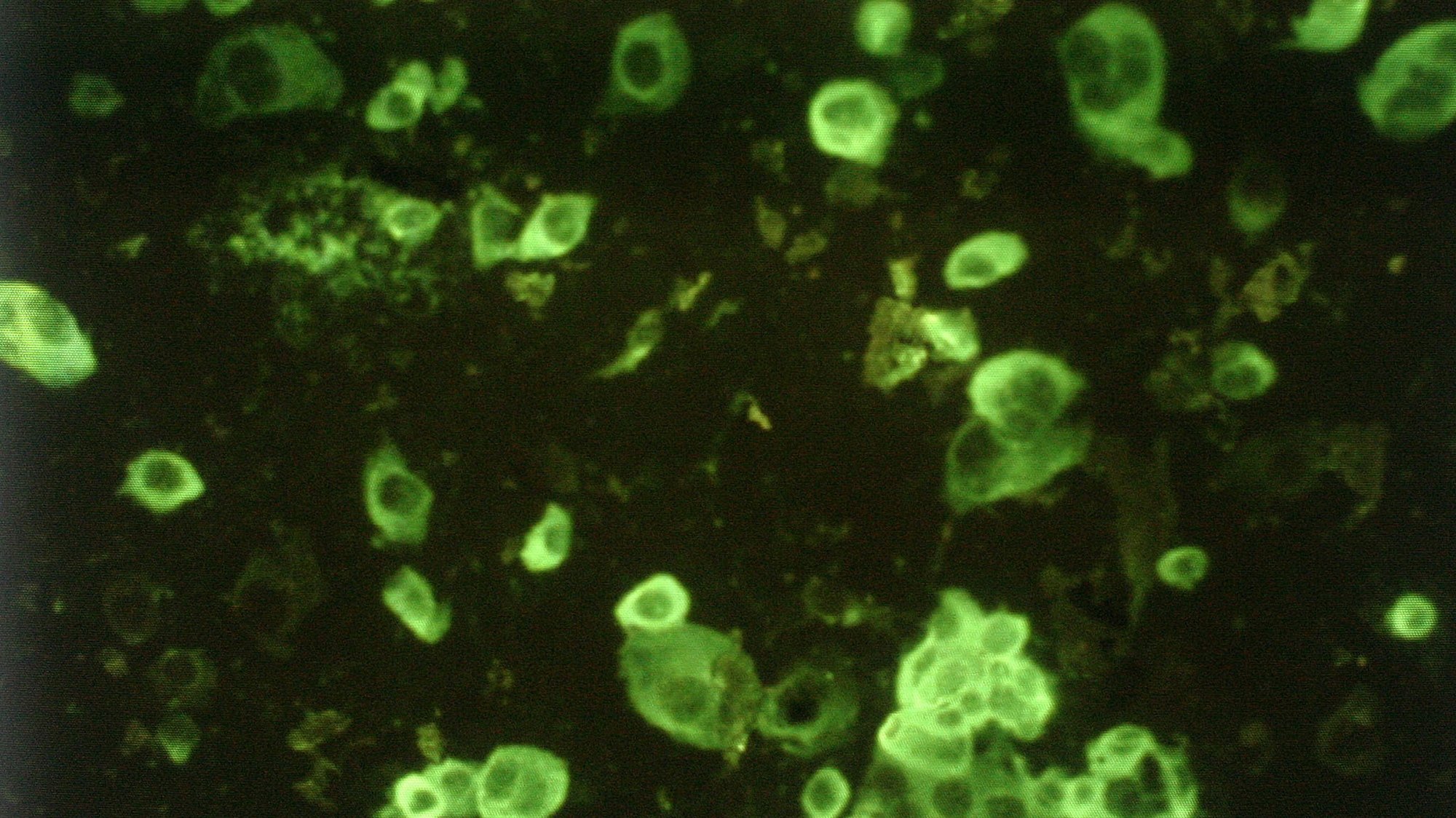An undated photo shows a microscopic image of human cells (darker) being infected with the Severe Acute Respiratory Syndrome (SARS) virus (lighter).  Hong Kong health authorities said 05 May 2003 that the death rate from the SARS virus in the territory could rise from the current 11 percent to 14 percent with concerns that the virus is mutating and could become more virulent. 
AFP PHOTO/Peter PARKS