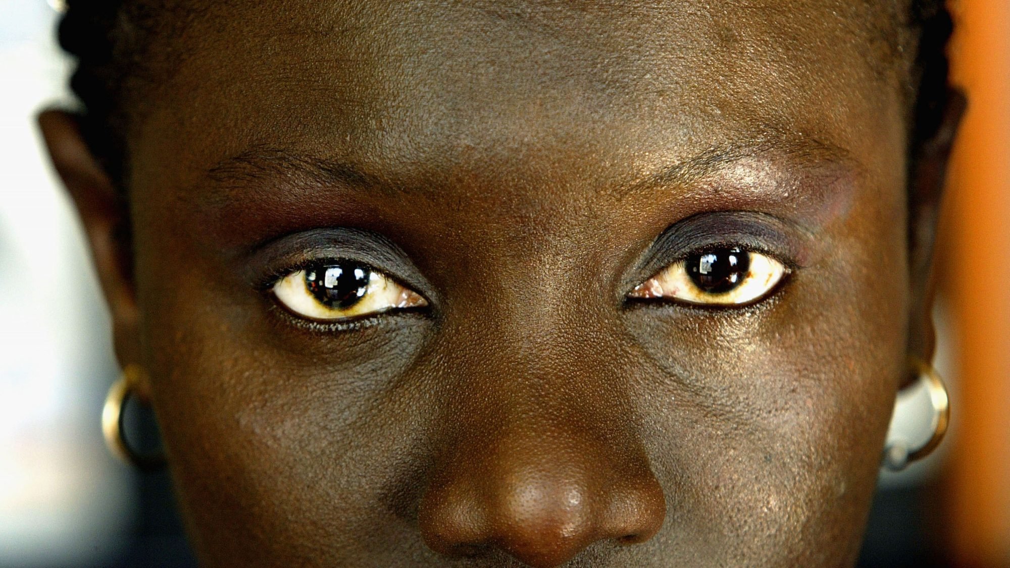 Estima-se que em Portugal vivam 6.500 mulheres excisadas, na maioria originárias da Guiné-Bissau