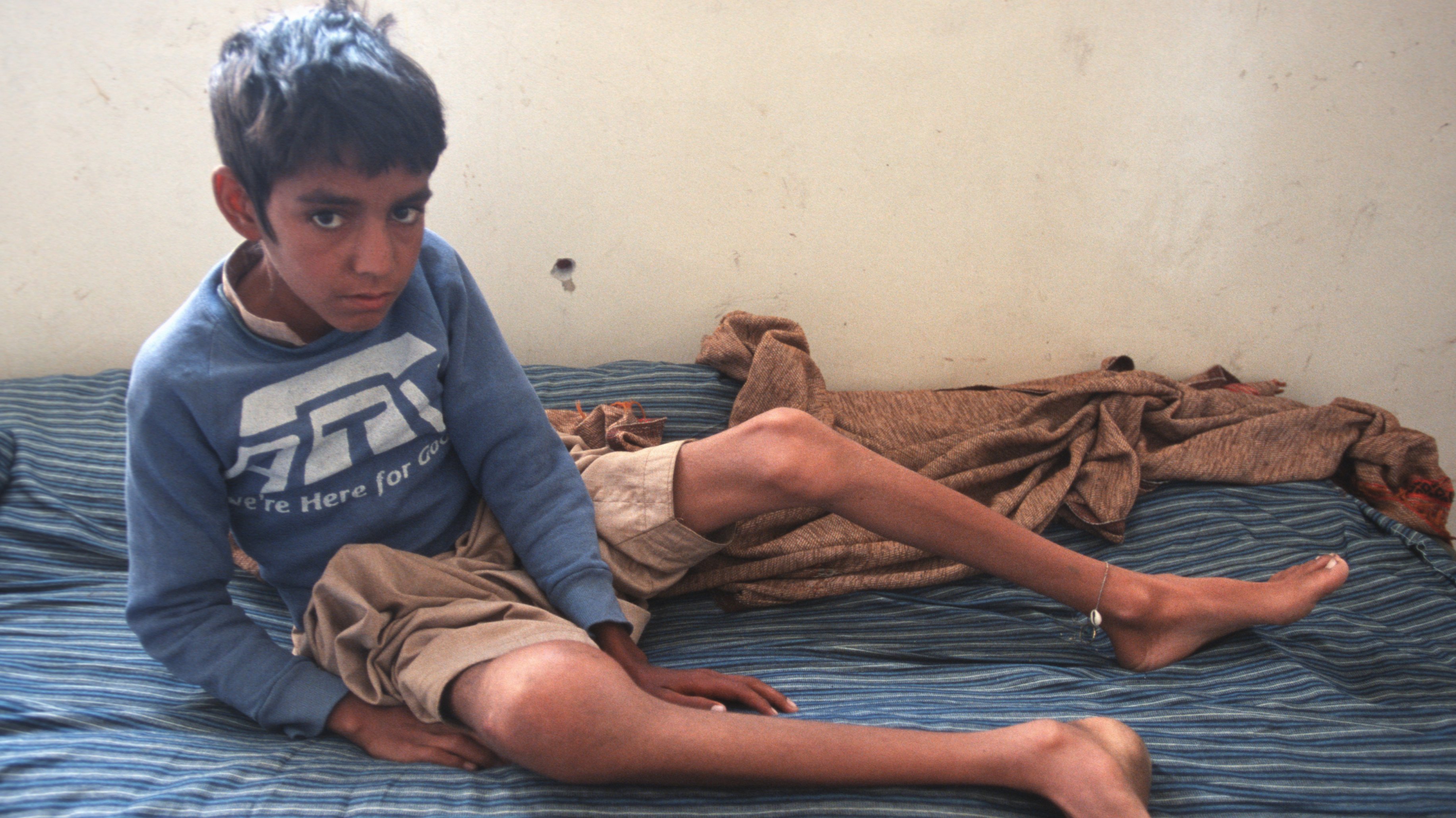 Rapaz afegão desnutrido, com polio