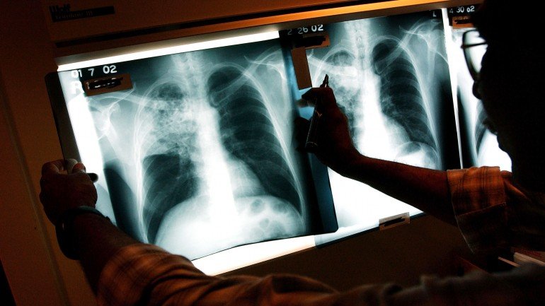 Tem vindo a registar-se um aumento da demora média entre o início dos sintomas e o diagnóstico da tuberculose