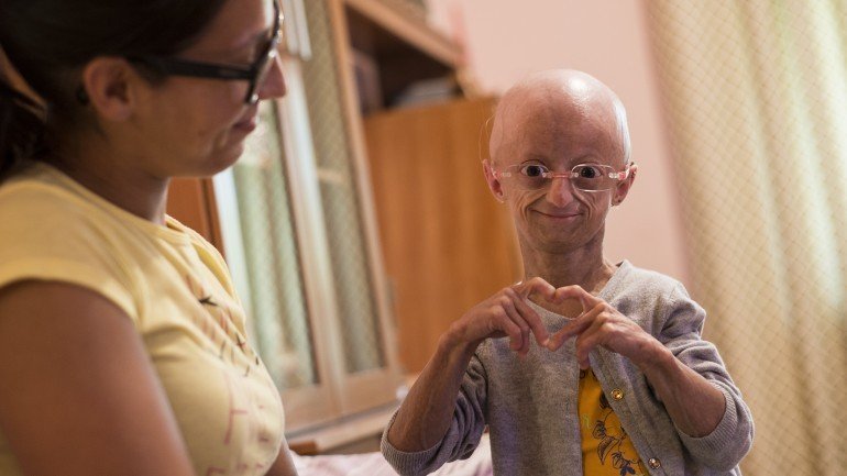 Cláudia Amaral sofre de progeria, uma deficiência genética rara, que provoca o envelhecimento precoce do corpo
