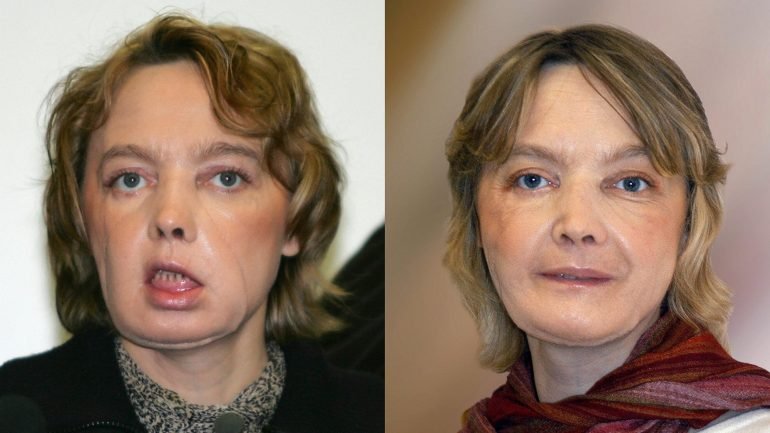 Isabelle Dinoire antes e depois do transplante, em 2005