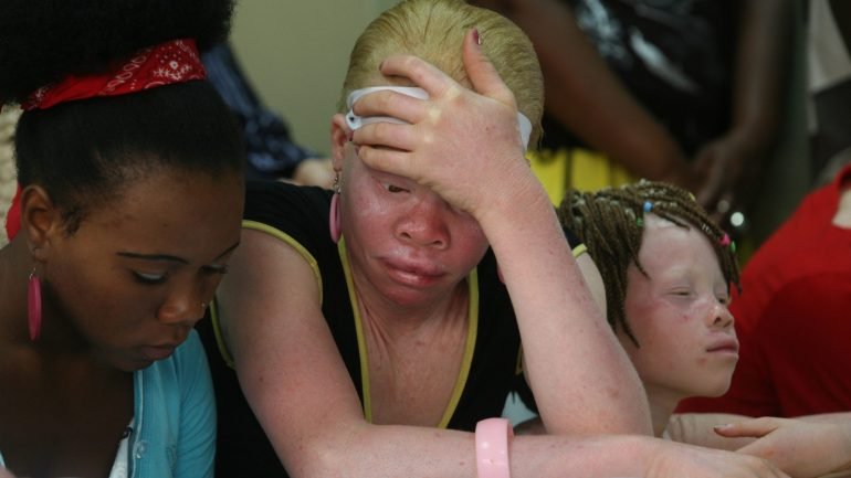 Os ataques a pessoas calvas surgem alguns meses após um aparente abrandamento da violência contra albinos para extração de órgãos, usados também em rituais