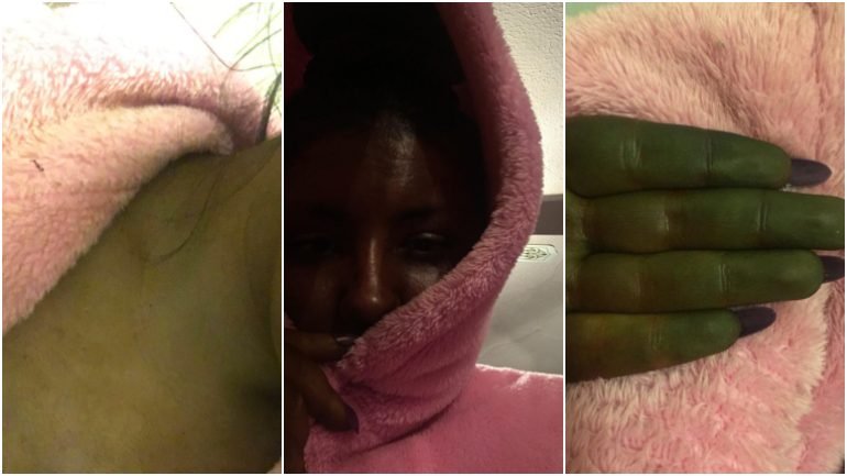 A jovem de 20 partilhou imagens da sua cara e mãos na sua página de Facebook