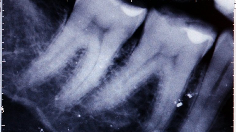 Segundo o Infarmed, estes dispositivos médicos são para aplicação na área dentária