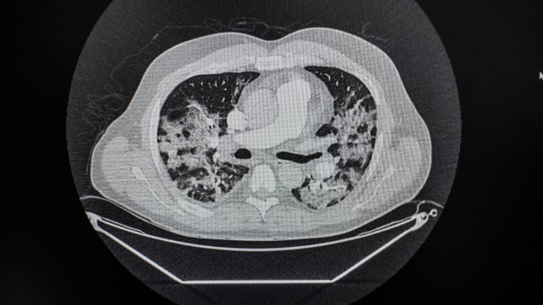 Alvéolos pulmonares destruídos, coágulos sanguíneos e uma pasta que parece pus, são algumas das consequências para os pulmões