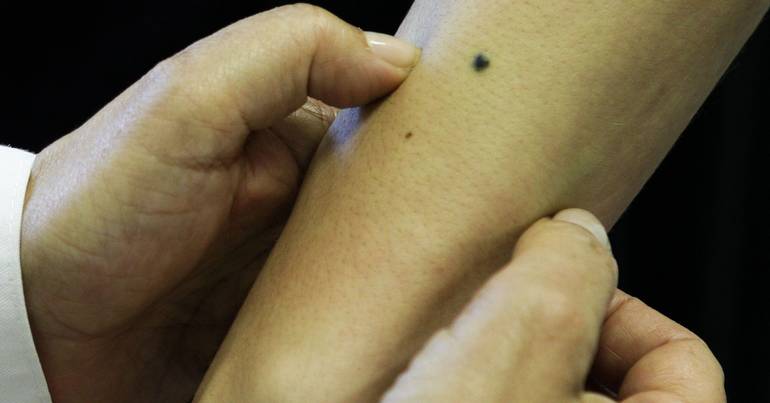 Investigadores criam hidrogel inovador para tratar melanoma