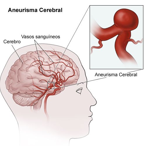 8 Respostas Para Perceber O Que E Um Aneurisma Cerebral Como Se Trata E Quais As Consequencias Observador